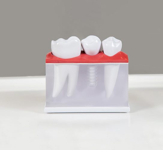 Dental Implants in Spring