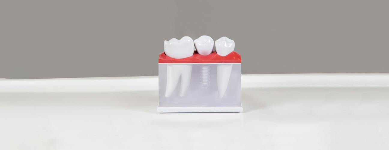 Dental Implants