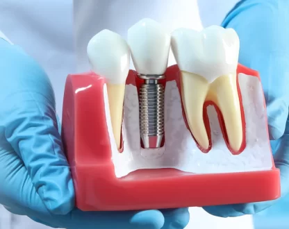A Detailed Guide to Full Arch Dental Implants