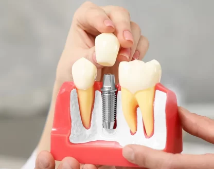 Dental Implants: A Comprehensive Overview