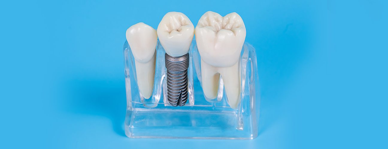 The Best Guide to Dental Implants: Everything You Must Know