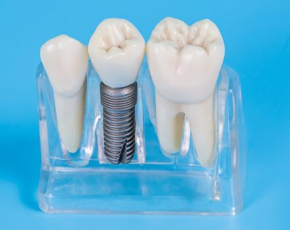 The Best Guide to Dental Implants: Everything You Must Know