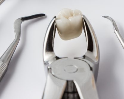 Tooth Extractions: When and Why They Are Necessary