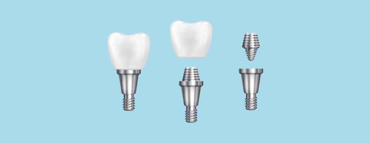 What Are Dental Implants? A Complete Guide to Tooth Replacement