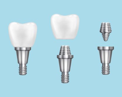 What Are Dental Implants? A Complete Guide to Tooth Replacement