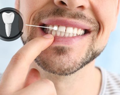 What to Expect During a Tooth Implant Procedure